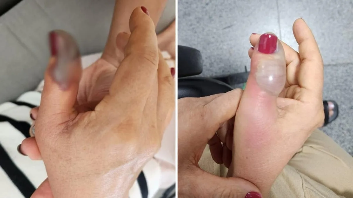 idosa-vai-fazer-a-unha-em-salao-de-goiania-e-perde-ponta-de-dedo-apos-infeccao