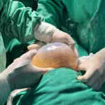 ‘lindo-demais’:-mae-de-bebe-que-nasceu-empelicado-em-goiania-relata-surpresa