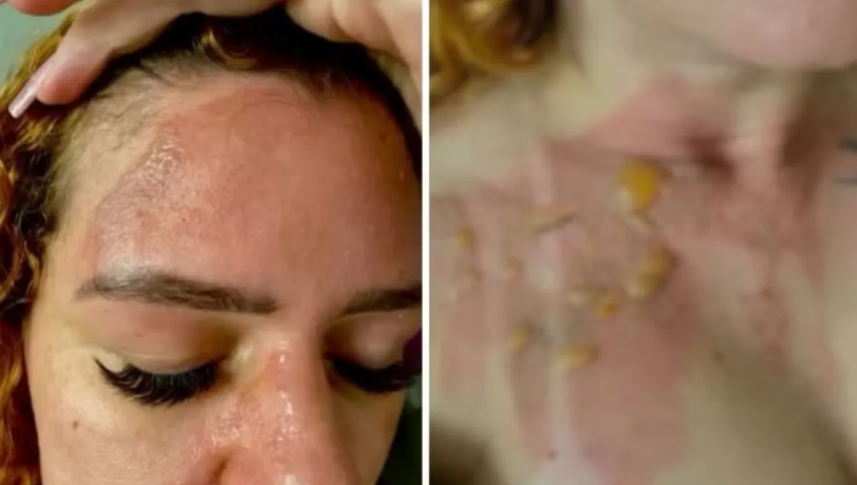 influencer-fica-com-queimaduras-no-rosto-apos-panela-de-pressao-explodir