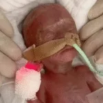 bebe-nasce-16-semanas-antes-do-previsto-na-alemanha:-‘milagre’