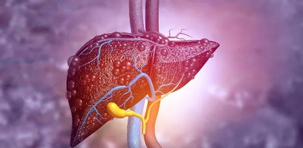 gordura-no-figado-bagunca-o-corpo:-como-o-coracao-sente-o-impacto-–-uol
