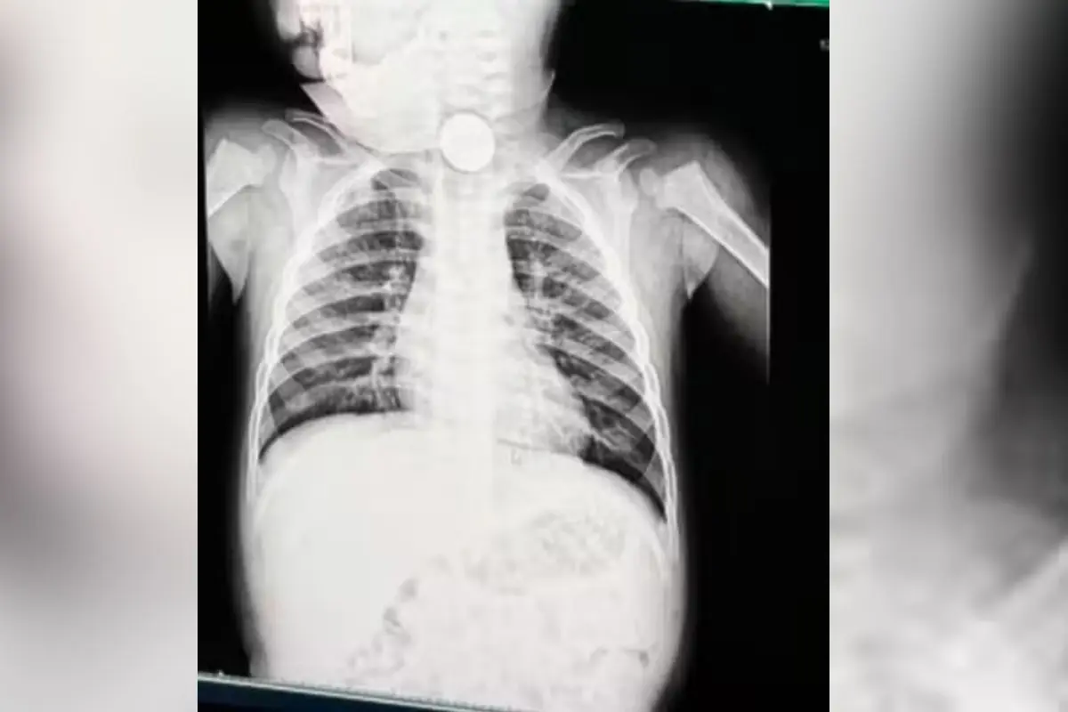 bateria-de-brinquedo-faz-bebe-de-1-ano-ir-parar-no-hospital-com-inicio-de-necrose-em-goiania