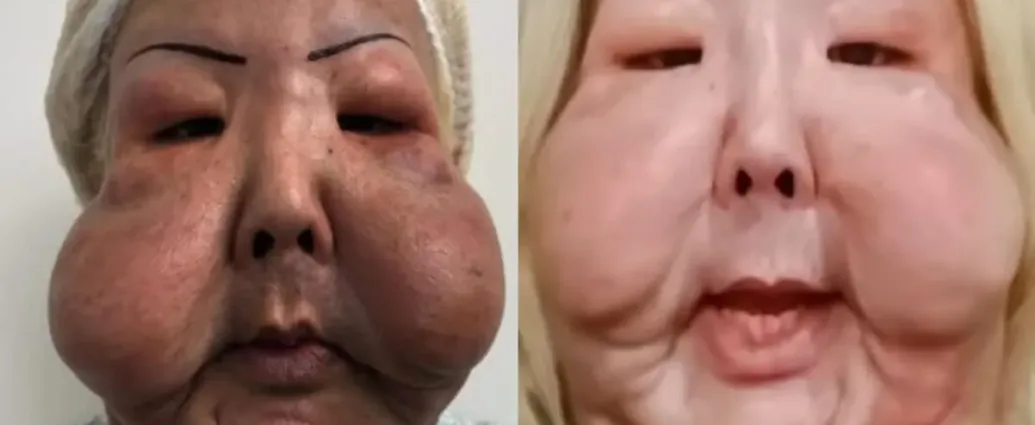 imagens-fortes:-medico-mostra-oleo-mineral-enrijecido-retirado-do-rosto-de-juju-do-pix