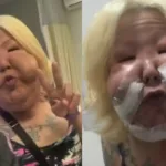 imagens-fortes:-medico-mostra-2a-cirurgia-para-retirada-de-oleo-mineral-do-rosto-de-juju-do-pix