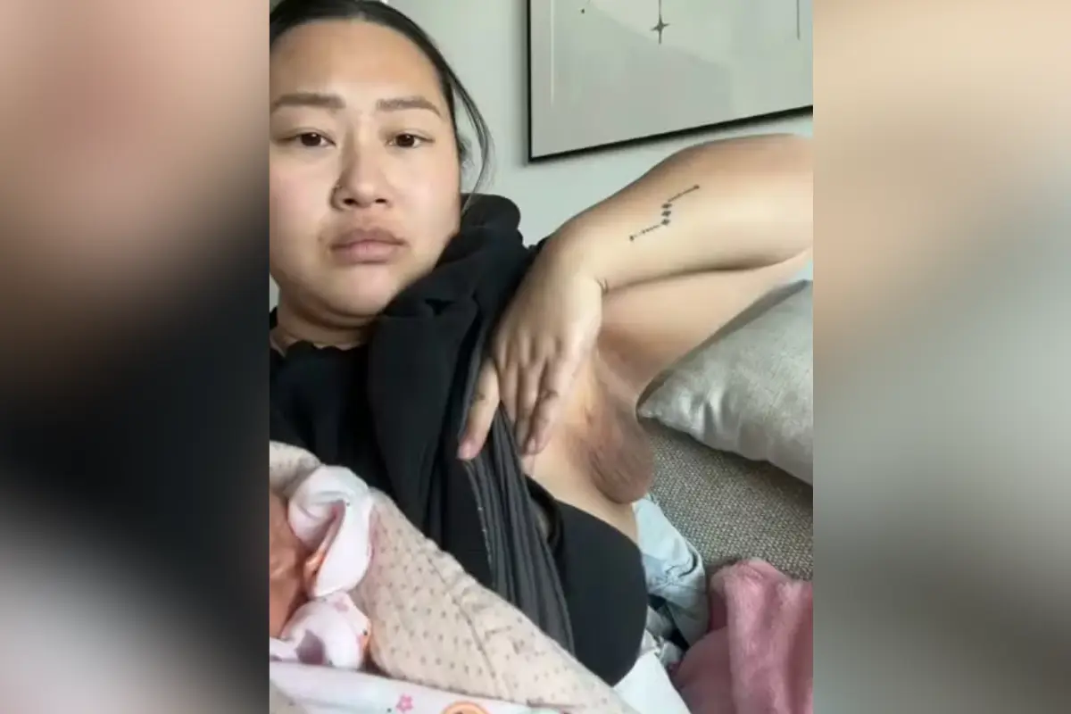 mulher-desenvolve-‘terceiro-seio’-apos-dar-a-luz:-entenda-o-que-e-a-polimastia