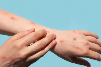 brasil-registra-48-casos-de-mpox-nos-primeiros-meses-de-2026