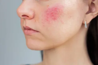 mulher-de-goiania-relata-susto-ao-descobrir-que-tinha-lupus:-‘senti-medo-imediato’