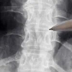 neurologistas-alertam-para-falta-de-evidencias-sobre-acao-da-polilaminina-em-lesao-medular