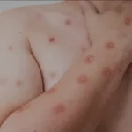 goias-investiga-cinco-casos-suspeitos-de-mpox