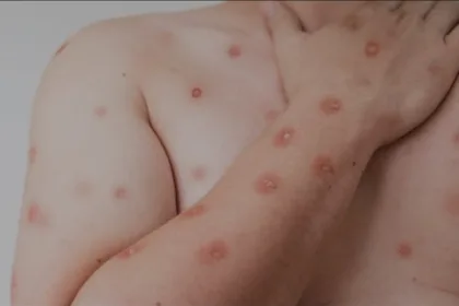 goias-investiga-cinco-casos-suspeitos-de-mpox