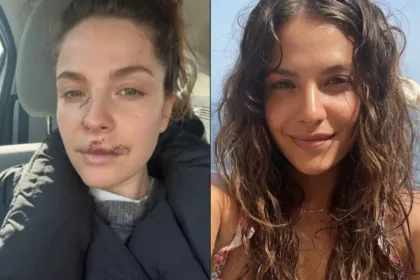 atriz-de-‘the-good-doctor’-revela-ter-sofrido-ataque-de-cachorro-e-mostra-rosto-ferido