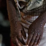 mpox-no-brasil:-numero-de-casos-confirmados-em-2026-sobe-para-140-–-jovem-pan