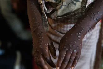 mpox-no-brasil:-numero-de-casos-confirmados-em-2026-sobe-para-140-–-jovem-pan