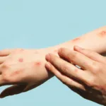 sobe-para-140-o-numero-de-casos-confirmados-de-mpox-em-2026-no-brasil