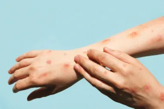 sobe-para-140-o-numero-de-casos-confirmados-de-mpox-em-2026-no-brasil