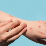 brasil-chega-a-140-casos-confirmados-de-mpox-em-2026