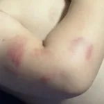 sc:-bebe-de-11-meses-volta-da-creche-com-mordidas-e-policia-investiga