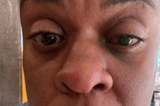 “voltei-a-enxergar”:-cacau-protasio-se-recupera-apos-reacao-a-pomada-capilar