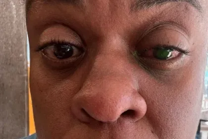 “voltei-a-enxergar”:-cacau-protasio-se-recupera-apos-reacao-a-pomada-capilar