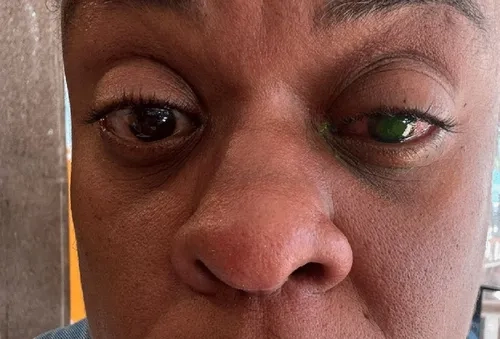 “voltei-a-enxergar”:-cacau-protasio-se-recupera-apos-reacao-a-pomada-capilar