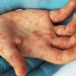 ministerio-da-saude-confirma-caso-de-sarampo-no-rio-de-janeiro