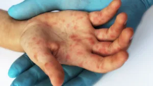 ministerio-da-saude-confirma-caso-de-sarampo-no-rio-de-janeiro