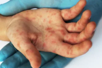 ministerio-da-saude-confirma-caso-de-sarampo-no-rio-de-janeiro