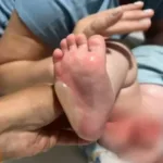 bebe-sofre-queimaduras-em-29%-do-corpo-apos-banho-em-escola-de-rio-verde