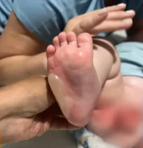 bebe-sofre-queimaduras-em-29%-do-corpo-apos-banho-em-escola-de-rio-verde