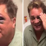 leonardo-sofre-acidente-durante-pescaria-e-fica-de-olho-roxo