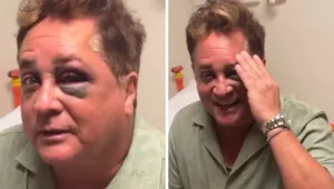 leonardo-sofre-acidente-durante-pescaria-e-fica-de-olho-roxo