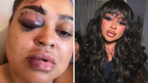o-que-aconteceu-com-rizia-cerqueira?-ex-bbb-mostra-rosto-machucado-e-detalha-acidente-–-nsc-total