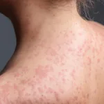 carolina-do-sul-declara-fim-de-surto-de-sarampo,-mas-novos-focos-emergem-nos-eua