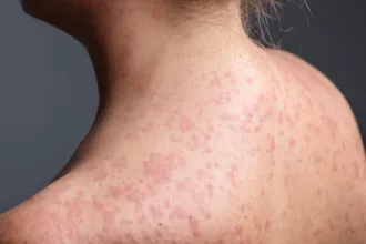 carolina-do-sul-declara-fim-de-surto-de-sarampo,-mas-novos-focos-emergem-nos-eua