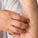 febre-oropouche:-saiba-identificar-sintomas-e-a-diferenca-para-dengue