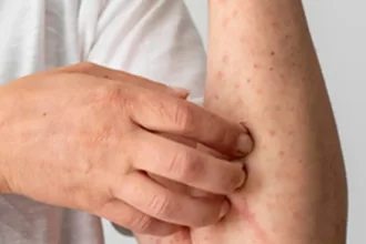 febre-oropouche:-saiba-identificar-sintomas-e-a-diferenca-para-dengue