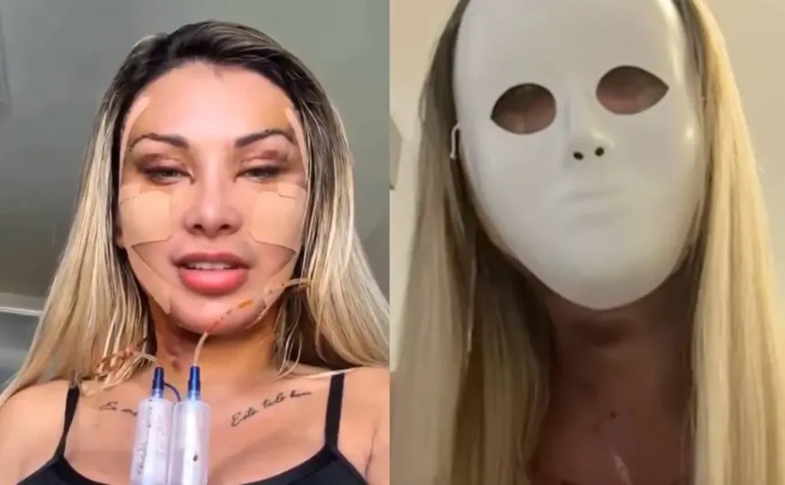 video:-andressa-urach-gasta-r$-100-mil-em-cirurgias-platicas:-“rosto-novo-apos-o-divorcio”