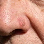 lucia-helena:-cancer-de-pele:-nao-e-so-o-melanoma-que-pode-se-espalhar-pelo-corpo-–-uol