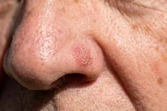 lucia-helena:-cancer-de-pele:-nao-e-so-o-melanoma-que-pode-se-espalhar-pelo-corpo-–-uol