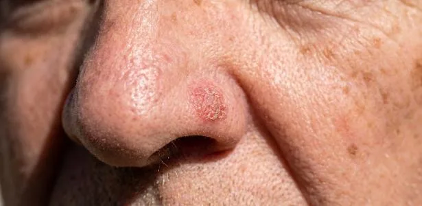 lucia-helena:-cancer-de-pele:-nao-e-so-o-melanoma-que-pode-se-espalhar-pelo-corpo-–-uol