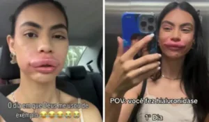 modelo-de-sc-fica-irreconhecivel-ao-remover-preenchimento-labial