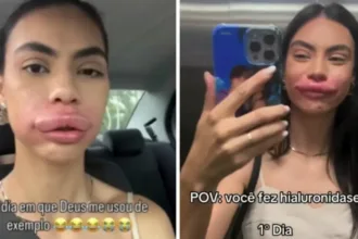 modelo-de-sc-fica-irreconhecivel-ao-remover-preenchimento-labial