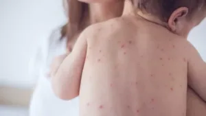 Vacina contra sarampo sendo aplicada em bebê