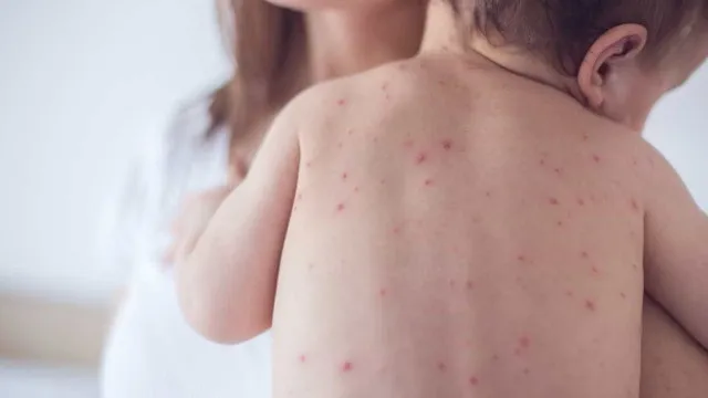 Vacina contra sarampo sendo aplicada em bebê