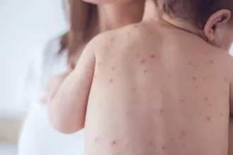 Bebê com sarampo em São Paulo