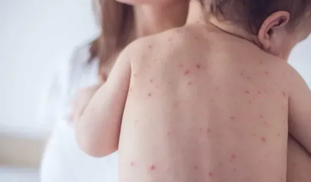 Bebê com sarampo em São Paulo