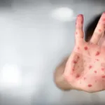 Vacinação contra sarampo em São Paulo