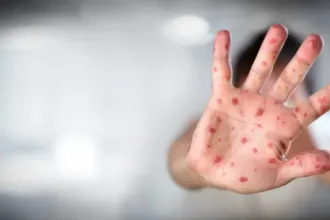 Vacinação contra sarampo em São Paulo