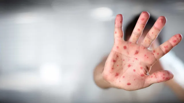 Vacinação contra sarampo em São Paulo