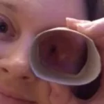 cirurgia-para-cancer-na-cavidade-ocular-faz-mulher-desenvolver-habilidade-inusitada